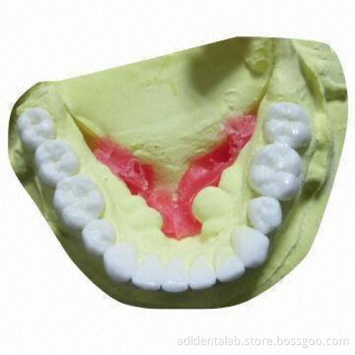 Diagnostic Wax-up